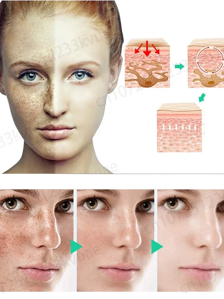 Sardine Remover + Essence: Quickly Removes Freckles, Dark Spots, Melasma, Age Spots, and Brightens Skin