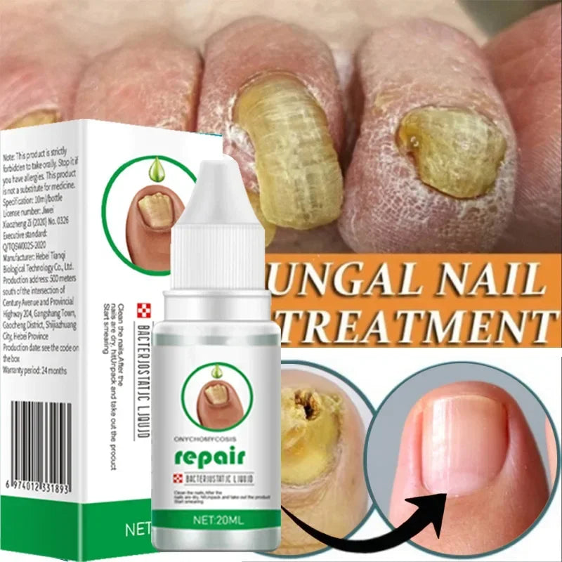 Toe & Hand Nail Fungus Treatment Serum: Anti-Infection Gel for Onychomycosis