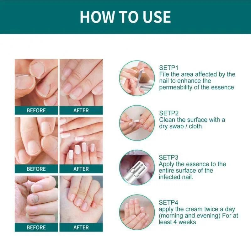 Toe & Hand Nail Fungus Treatment Serum: Anti-Infection Gel for Onychomycosis