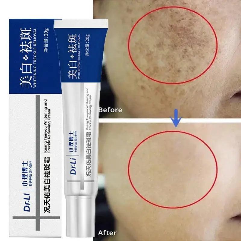 Effective Whitening Cream: Removes Melasma, Dark Spots, Moisturizes - Trendy Mix