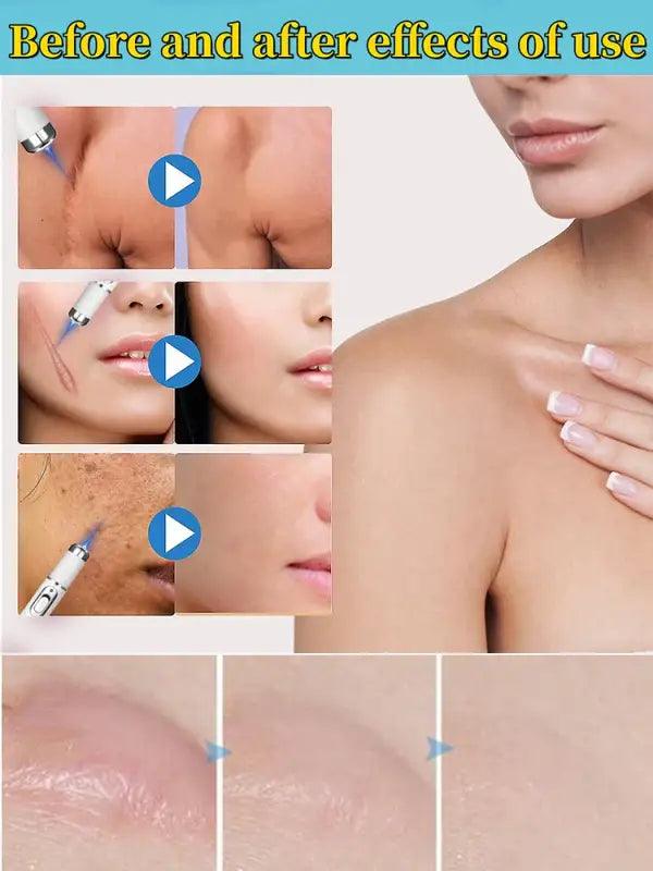 Laser Scar ’hot Selling’ - Trendy Mix